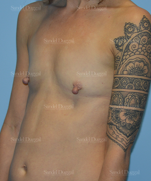 breast augmentation patient