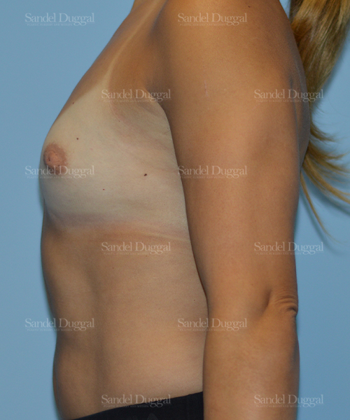 breast augmentation patient