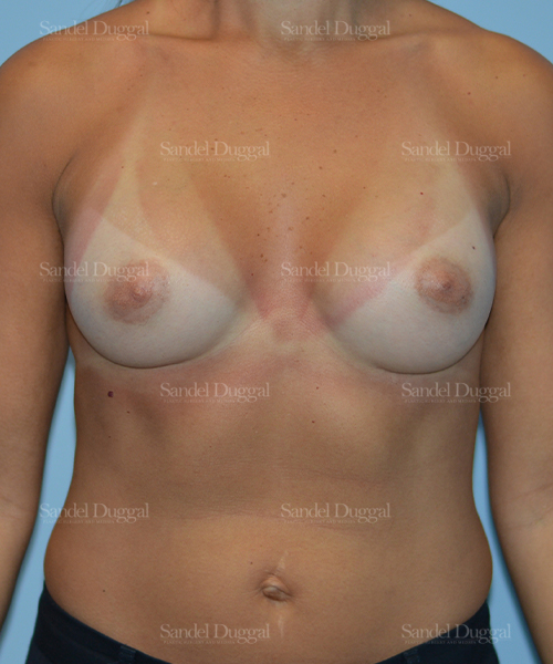 breast augmentation patient