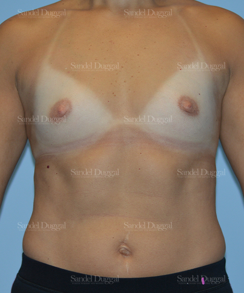 breast augmentation patient