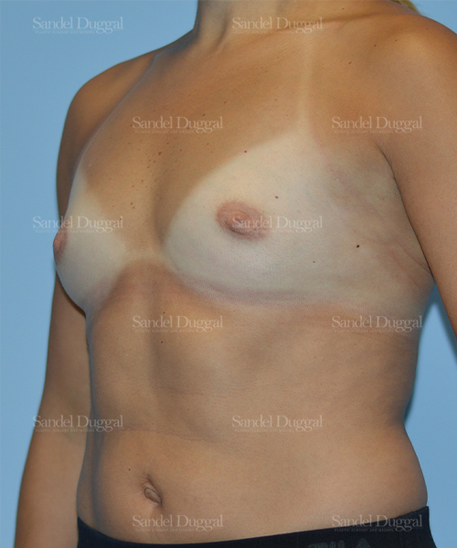breast augmentation patient