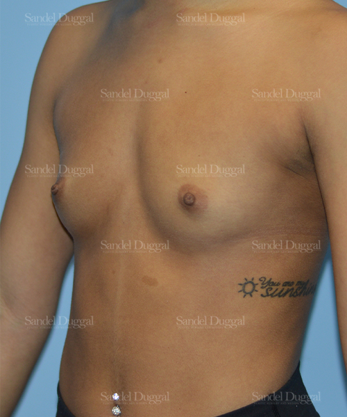 breast augmentation patient