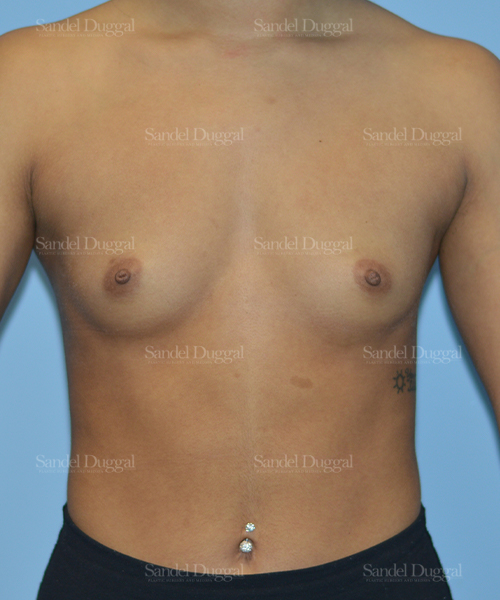 breast augmentation patient