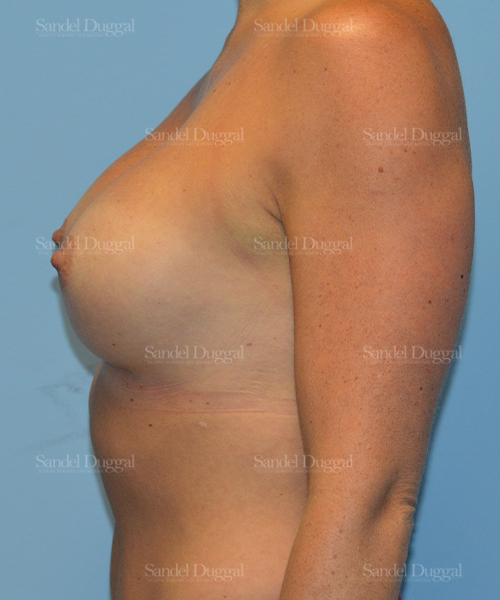 breast augmentation patient