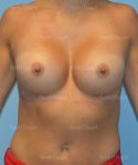breast augmentation patient