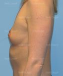 breast augmentation patient