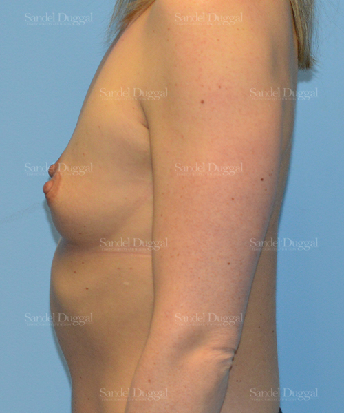 breast augmentation patient