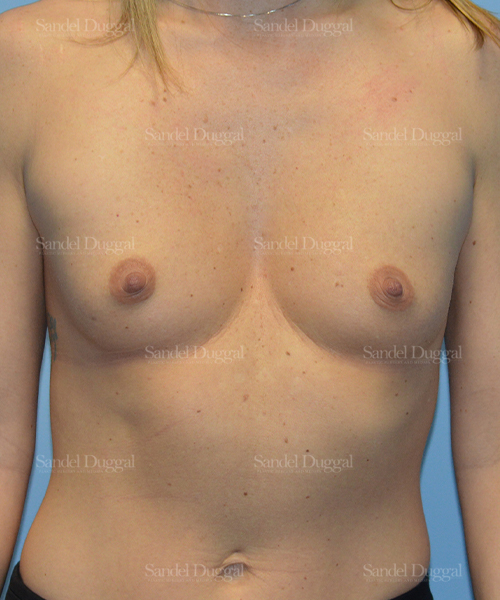 breast augmentation patient