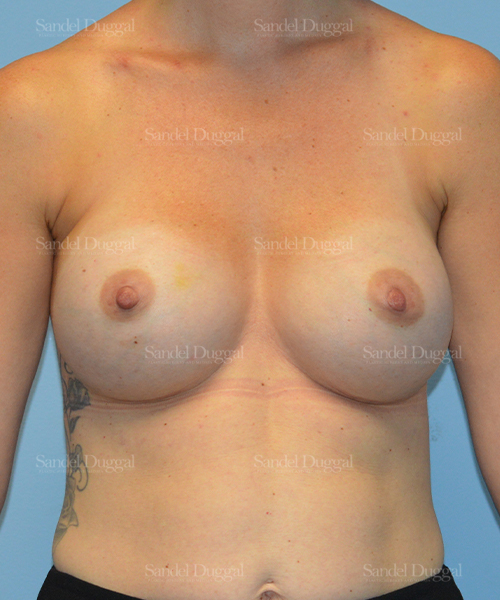 breast augmentation patient