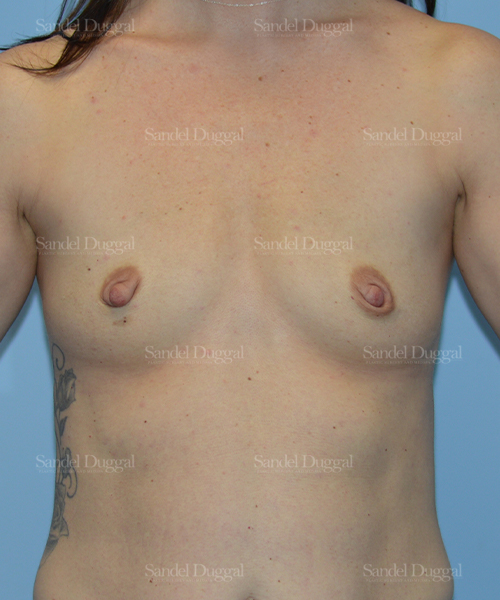 breast augmentation patient
