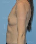breast augmentation patient
