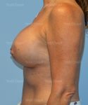 breast augmentation patient