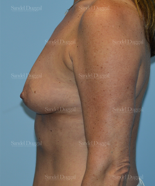 breast augmentation patient