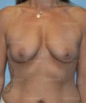 breast augmentation patient