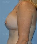 breast augmentation patient