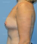 breast augmentation patient