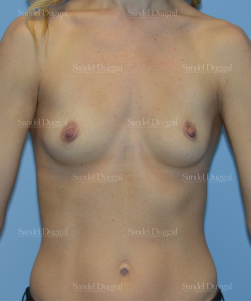 breast augmentation patient