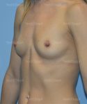 breast augmentation patient