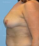 breast augmentation patient