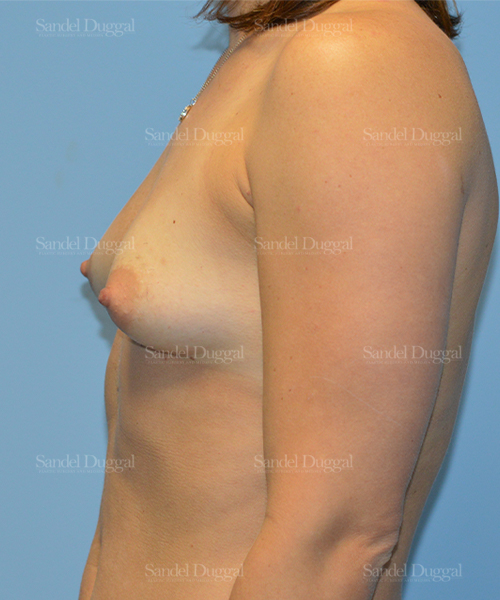 breast augmentation patient