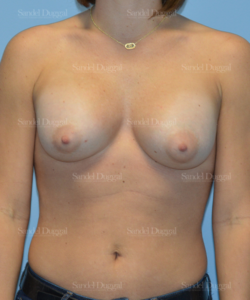 breast augmentation patient