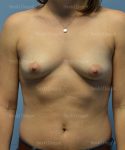 breast augmentation patient