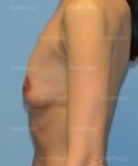 breast augmentation patient