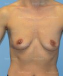 breast augmentation patient
