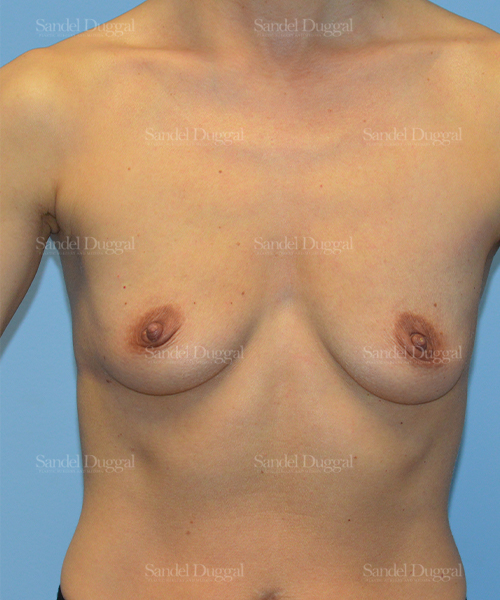 breast augmentation patient