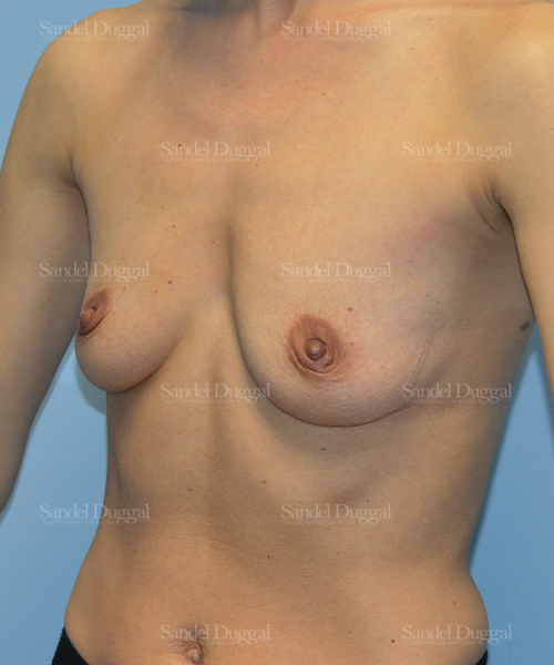 breast augmentation patient