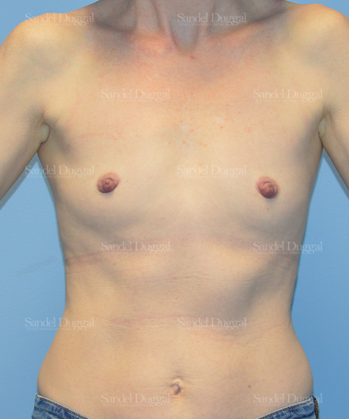 breast augmentation patient