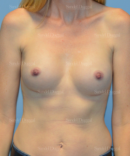 breast augmentation patient