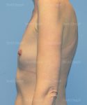 breast augmentation patient