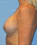 breast augmentation patient