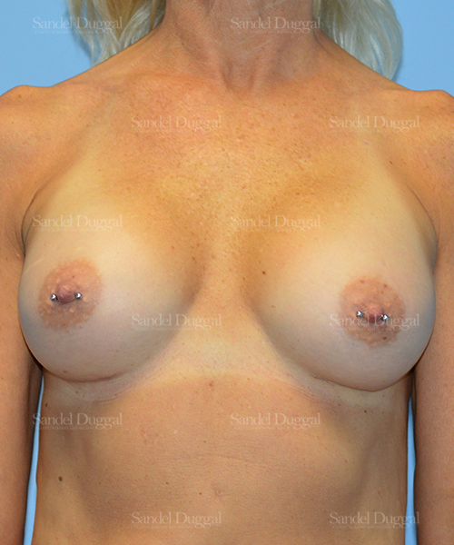 breast augmentation patient
