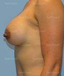 breast augmentation patient