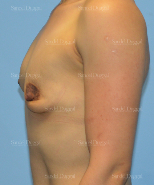 breast augmentation patient