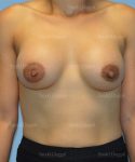 breast augmentation patient