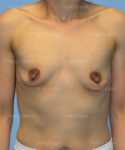 breast augmentation patient