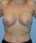 breast augmentation patient