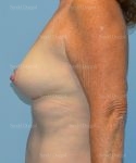 breast augmentation with lift patient