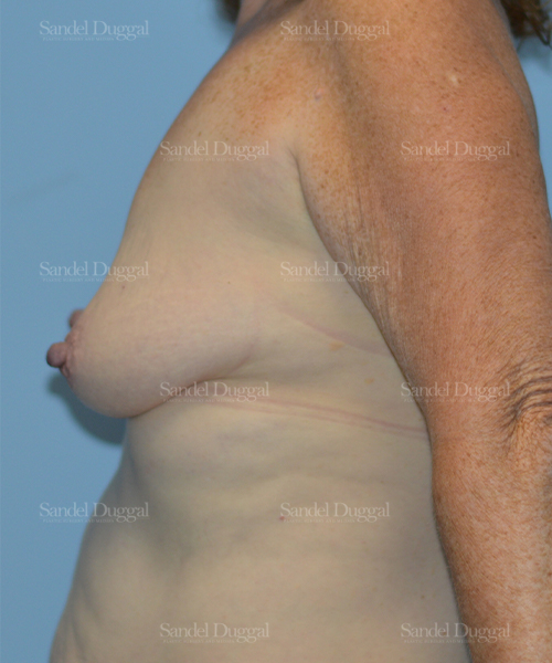 breast augmentation with lift patient