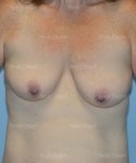 breast augmentation with lift patient
