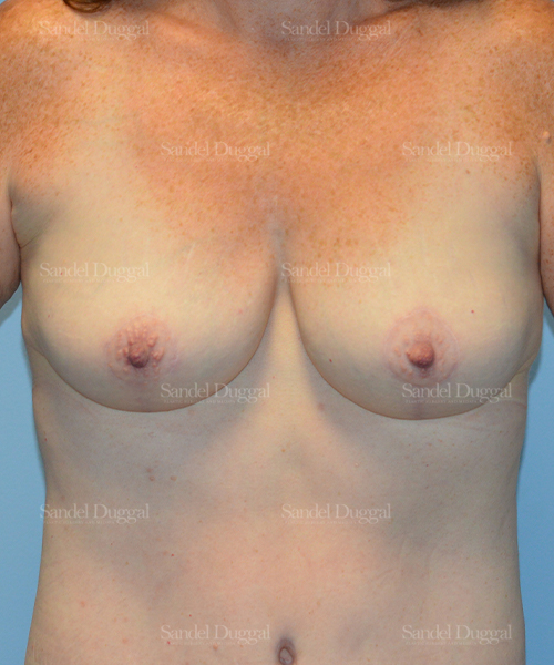 breast augmentation with lift patient