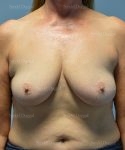 breast augmentation with lift patient