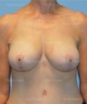 breast augmentation with lift patient