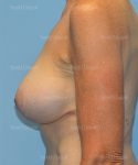 breast augmentation with lift patient