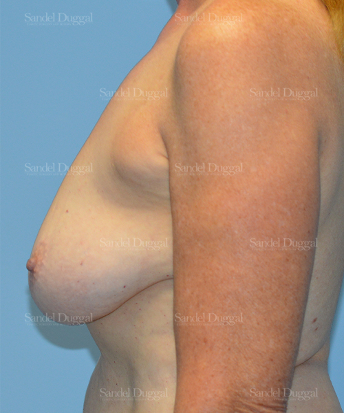 breast augmentation with lift patient