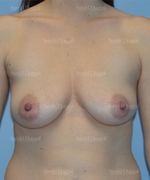 breast augmentation with lift patient