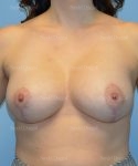 breast augmentation with lift patient